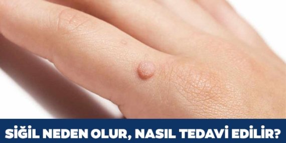 Siğil Nasıl Geçer? 2024